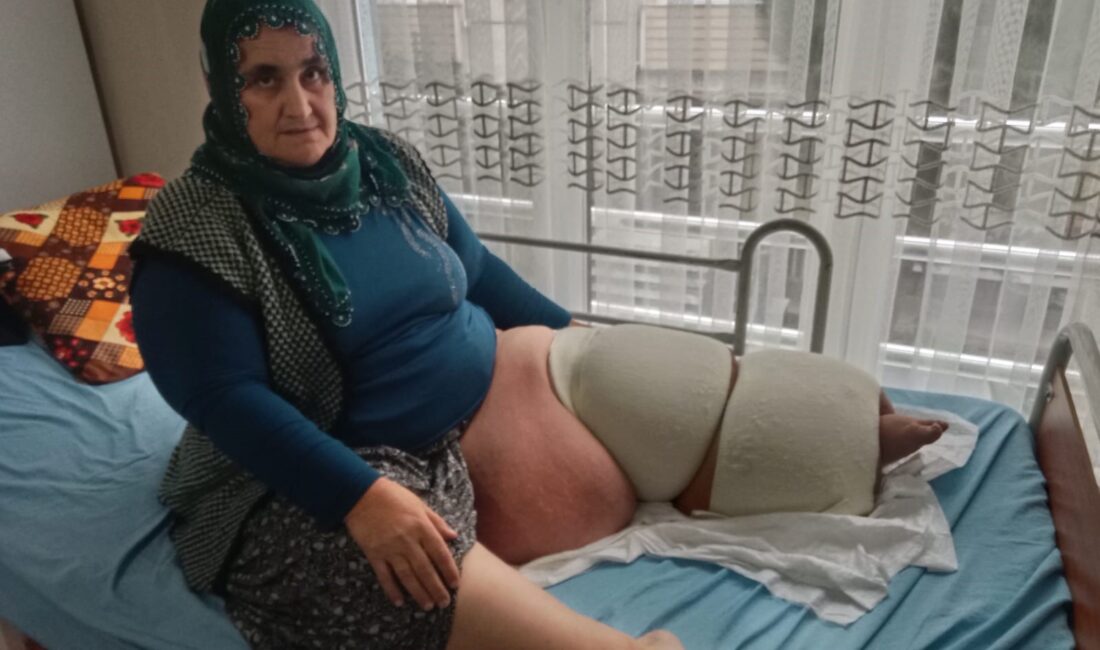 Fil hastalığı bacağını 100 kilo yaptı, tedavisinin devamı için destek bekliyor Mersin’in Tarsus ilçesinde yaşayan 53 yaşındaki kadın, 35 yıldır fil