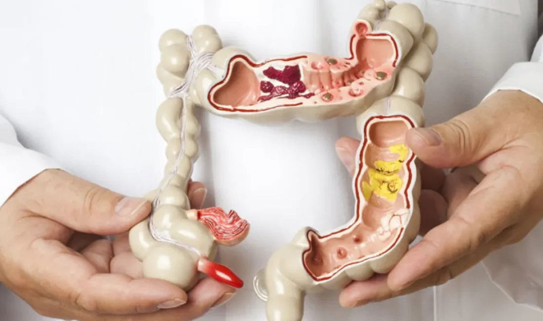 Kolorektal kanserin dünyada en sık görülen kanser türlerinden biri olduğunu