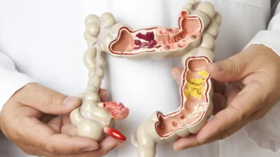 Kolorektal kanserin dünyada en sık görülen kanser türlerinden biri olduğunu