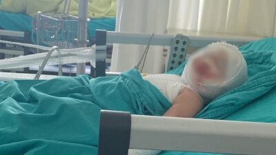 Mersin’de 9 aylıkken misafirlikte patlayan domates konservesi nedeniyle yüzü ve